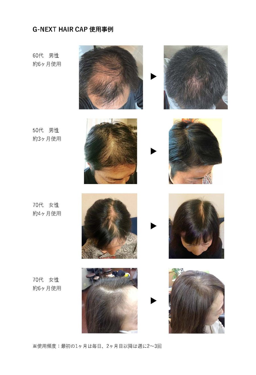 G-NEXT HAIR CAP の使用事例。60代男性約6ヶ月・50代男性約3ヶ月・70代女性約4ヶ月・70代女性約6ヶ月の使用前後の頭頂部
